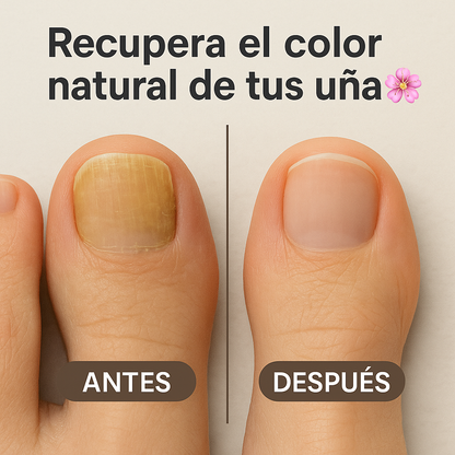 PARCHES ELIMINA HONGOS DE UÑAS